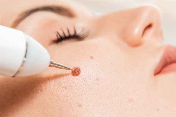 CryoPen: 5 Skin Concerns It May Be Used to Treat 3 What actually happens during a CryoPen treatment Hitchin?