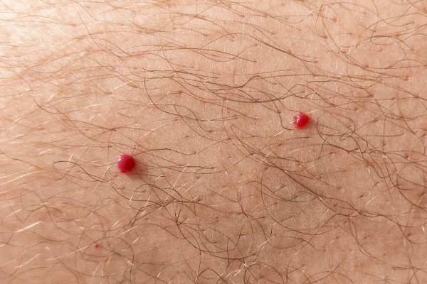 CryoPen: 5 Skin Concerns It May Be Used to Treat 2 cherry angioma removal Hitchin