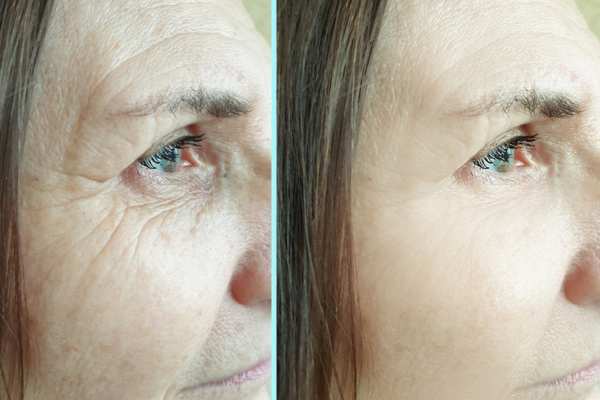 Why Do People Choose HIFU for a Non-Surgical Facelift? 4 How long can HIFU results last Hitchin?