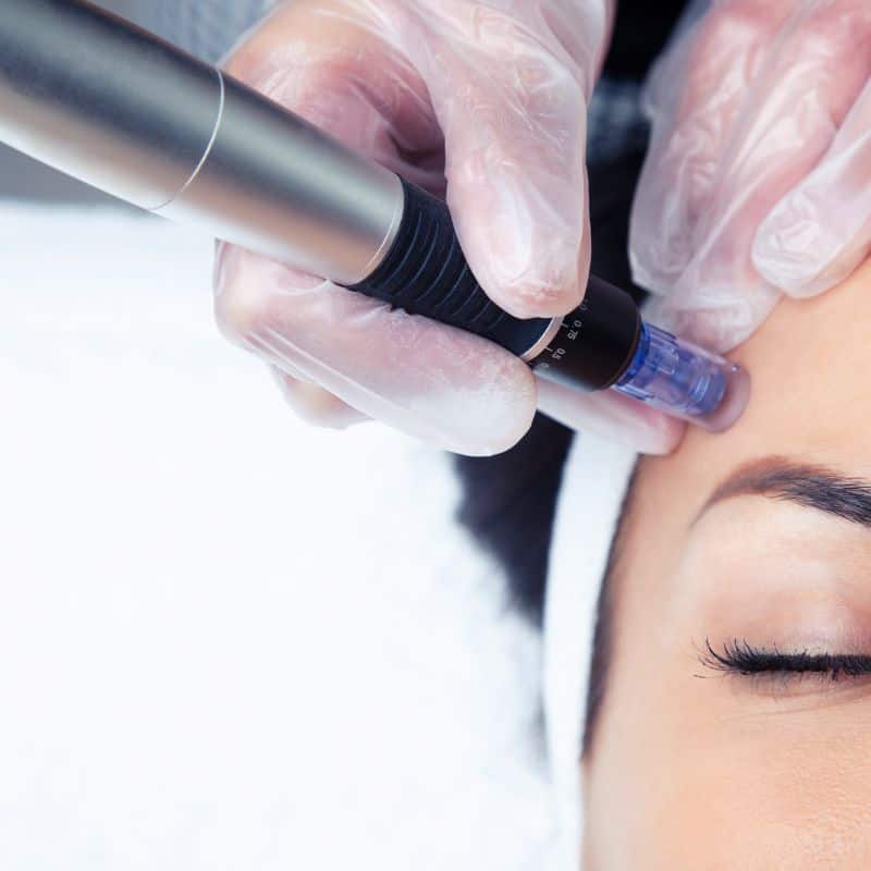 Morpheus8 treatment Hitchin from Lipo Sculpt - Book in today!