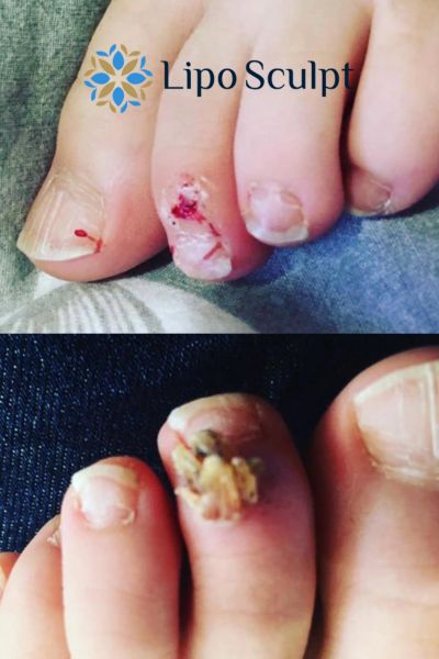 Wart removal customer results from Lipo Sculpt Hitchin
